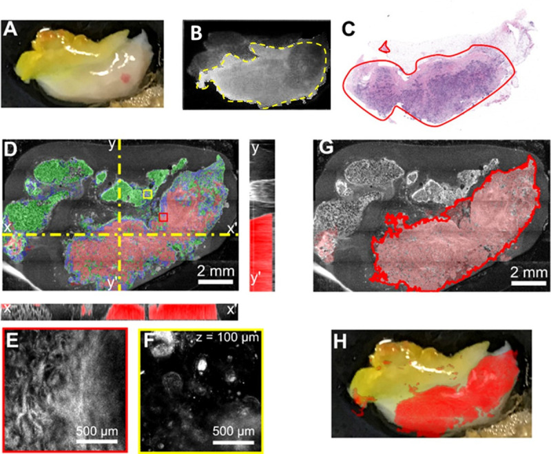 Positive margins identification on a small lumpectomy specimen using multimodal imaging and image classifiers.